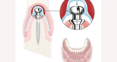 Atlas Denture Comfort secures new or existing dentures