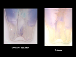 Slika 2c: Sleiman-Iandolo test. Rezultat uklanjanja boje pasivnim ultrazvucnim ispiranjem (levo)i uređajem za irigaciju sa negativnim pritiskom korišćenim po intervalima preporučenim po Sleimanovoj fazi (desno). Uočljiva je ekstremna čistoća najdubljih delova dentinskih kanalića na slici desno. Ultrazvučna aktivacija Endovac sistem