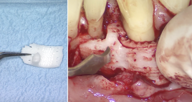 3-D-printed dental tissue: First human case of treatment fails in long term