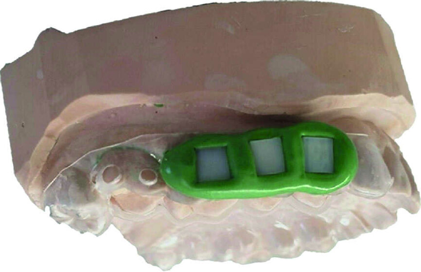 Fig. 1 : Gouttière intra-orale maxillaire pourvue de plaques d’email.