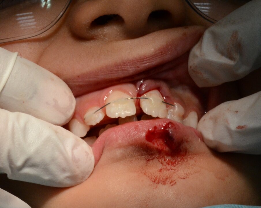 Figure 7. A passive composite and wire splint involved # 12 to 22. The lip was yet unsutured.