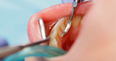 Badanie dostarcza nowych informacji na temat rozwoju i profilaktyki próchnicy zębów