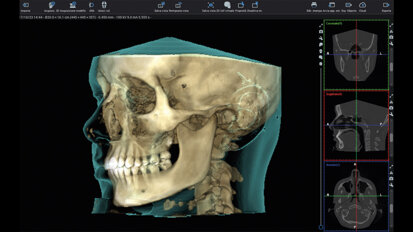 Utilizzo della tomografia computerizzata  a fascio conico, dei file STL  e dell’intelligenza artificiale