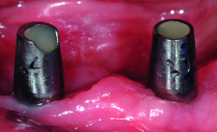 Fig. 17: Atlantis Conus Abutments torqued to specified level, obturated with Teflon tape and composite resin.
