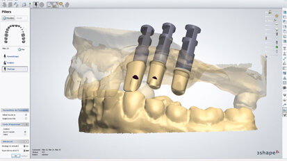 Realizzazione di un abutment implantare customizzato mediante CAD/CAM: una soluzione specifica per ogni caso clinico