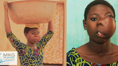 Mädchen in Togo von Gesichtstumor befreit
