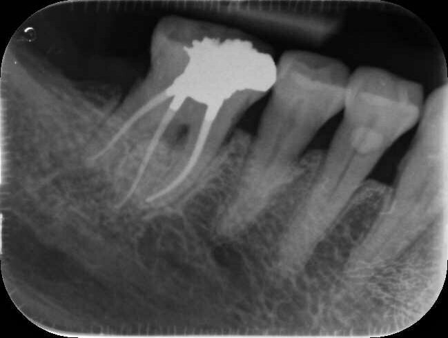 Fig. 14b: Case treated with Bassi Logic controlled memory nickel titanium files. Note the visualization of the third root on this lower molar and conservative canal preparation shape. (Courtesy of Dr. Alex Chan)