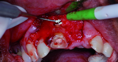 Use of mineral trioxide aggregate in endodontic retro-filling