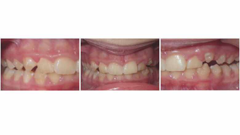 Progress after 6 months – notice the UL2 alignment while the bite is being corrected.