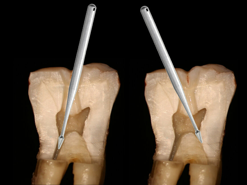 Fig. 4: Orifice-directed access in a molar utilizing Endoguide burs to conserve tooth structure while giving straight line access into the canals.
