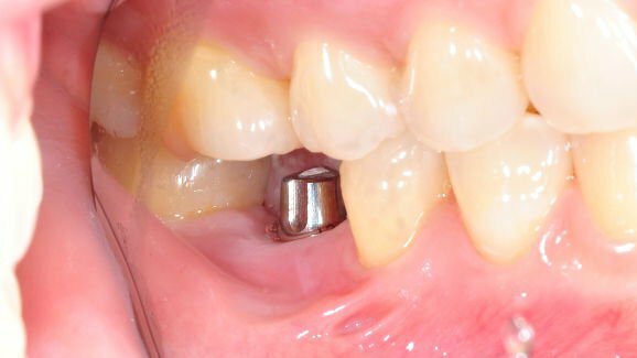 Inžinjeri razvili novi gel koji pouspješuje rast kosti oko zubnih implantata