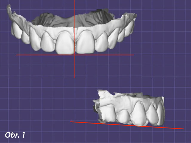 Obr. 1: Digitální model importovaný do dentálního softwaru exocad; červené čáry znázorňují středovou linii a okluzální rovinu odhadnutou z polohy zubů bez referenčních bodů