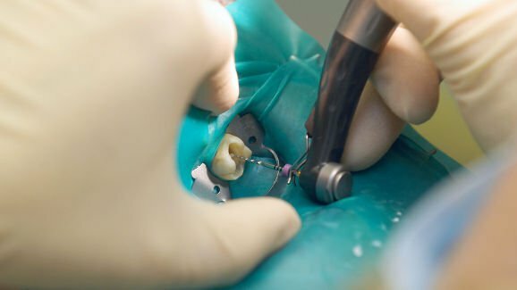 Publicado guia clínico para casos complicados de endodontia