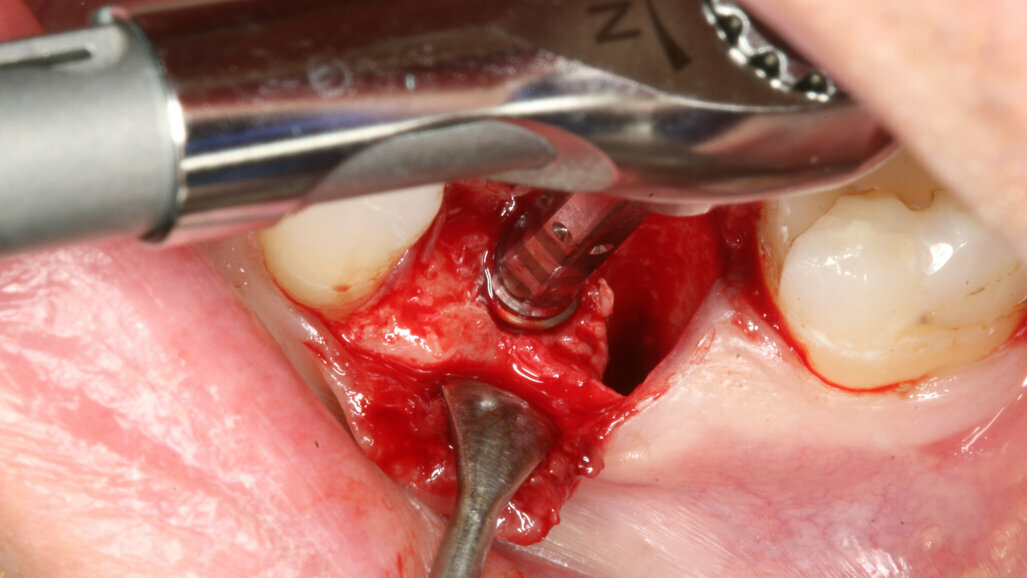 Immediate implant placement and provisionalisation of a mandibular first molar