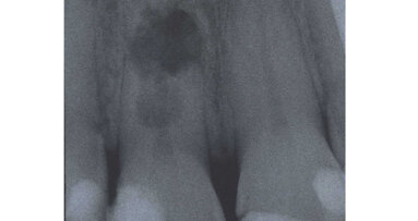 Case report: Internal root resorption rules out restoration