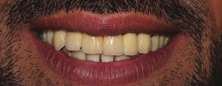 Figure 19:  Final result showing the cemented restorations no 7 and 8. 