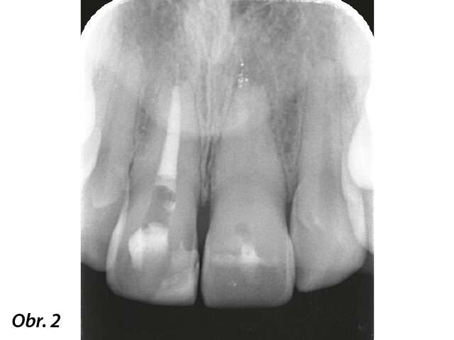 Předoperační rentgenový snímek ukazující těžkou kalcifikaci systému kořenových kanálků zubu 21.