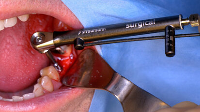 Straumann BLX implant: First human case study yields positive results for molar replacement