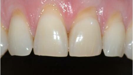 L’ipersensibilità dentinale