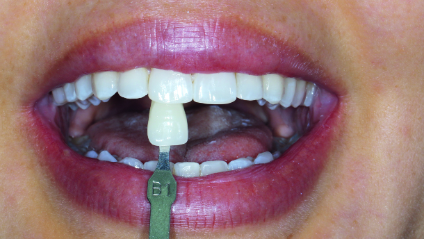 Update on tooth whitening and remineralisation with nHAp
