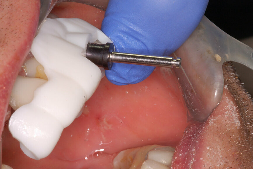 Fig. 8b: Using drill guides with long shanks to engage the sleeveless template allowed for sequential and accurate drilling of the tooth and subsequent bone for implant placement.