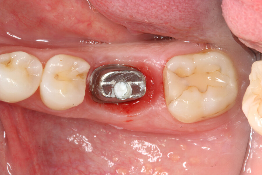 Fig. 16: Healed soft tissue around abutment eight weeks after implant placement.
