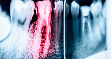Endodonzia al IX Congresso AIO di Chia: Un microcosmo che mantiene il suo fascino