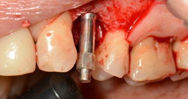 “We are not selling implants”—rethinking immediate dental implant loading