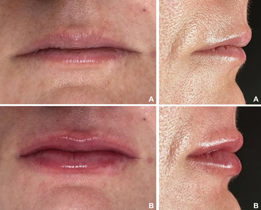 Fig. 1 - Paziente del gruppo con labbra più sottili prima del riempimento delle labbra (a) e 10 giorni dopo il riempimento (b).