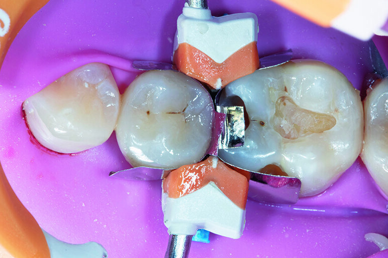 Fig. 4. Tooth #45 was restored first with Beautifil Injectable XSL shade A2 followed by Beautiful II LS shade A2 in snow-plow technique.