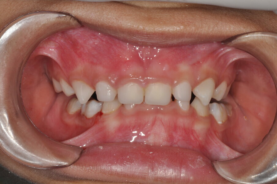 Fig. 10: Four month follow up showed good gingival health and no discoloration of the crowns.