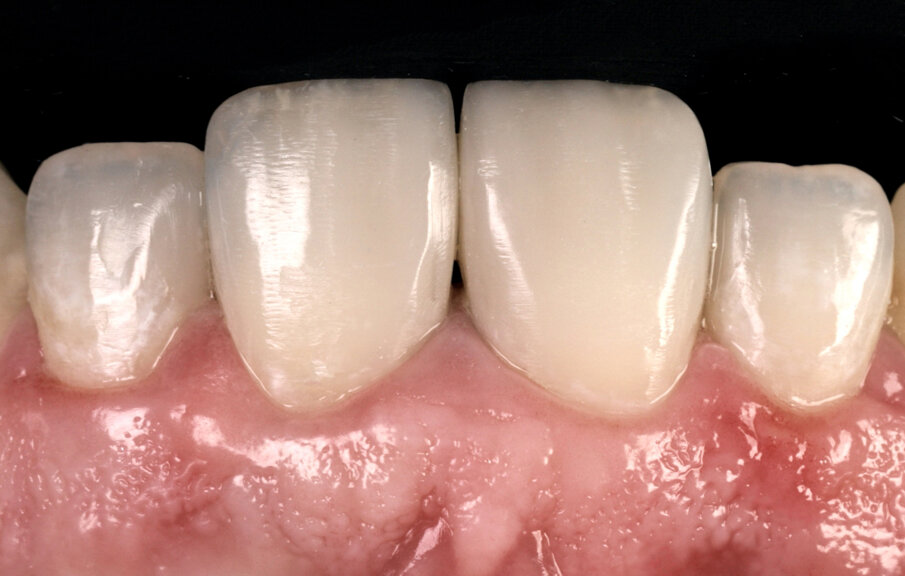 Fig. 18: Final restorations on tooth 11,12,21 & 22 completed with bioactive direct composites that helped enhance the patients smile and meet his expectations.