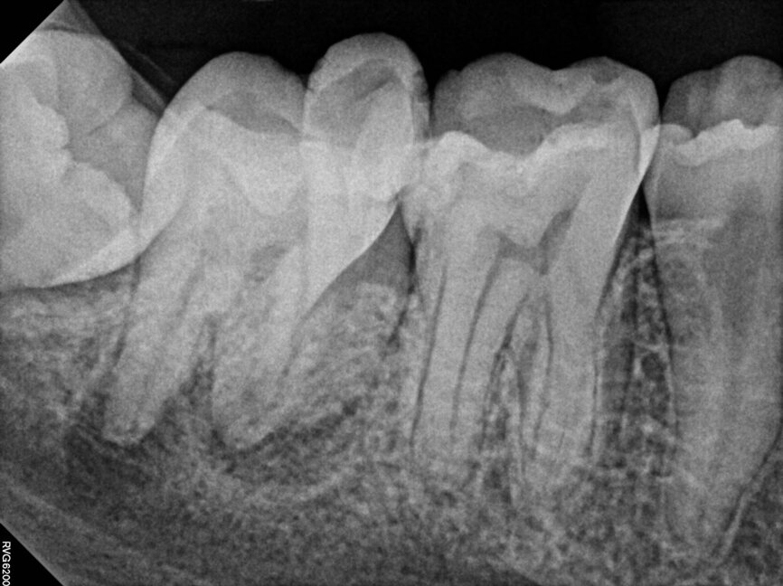 Fig. 15a: Cased treated with PIPs (Photon Induced Photoacoustic Streaming). Note the orifice barrier placed in composite to protect the endodontic treatment from coronal leakage. (Courtesy of Dr. Paula Elmi)