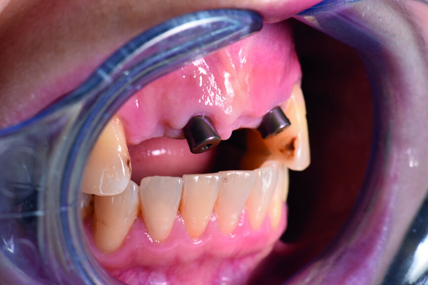 Fig. 10: The overjet and overbite between the implants and the mandibular anterior teeth.