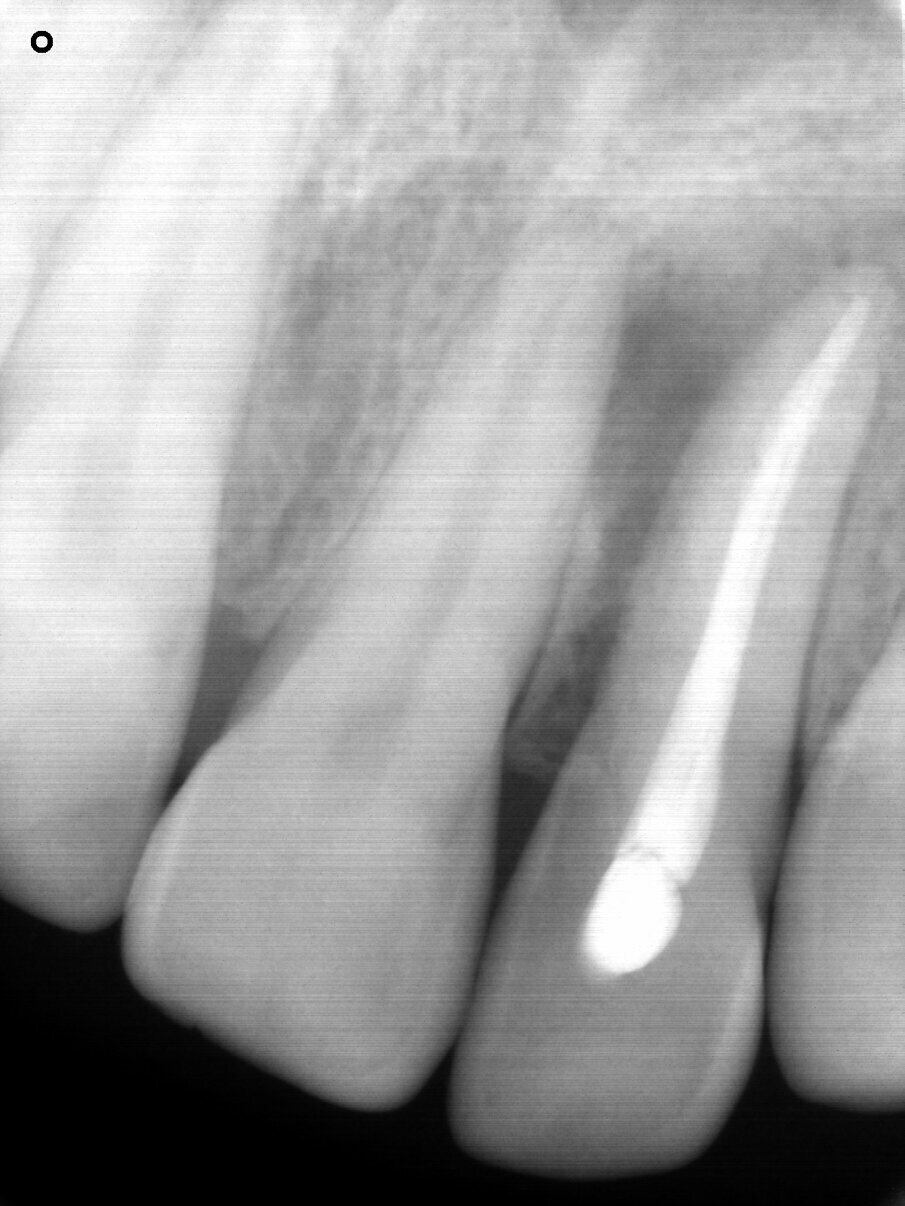 Fig. 2: Periapical radiograph showing the horizontal fracture of the endodontically treated tooth #22 and an unfavourable root–crown ratio.