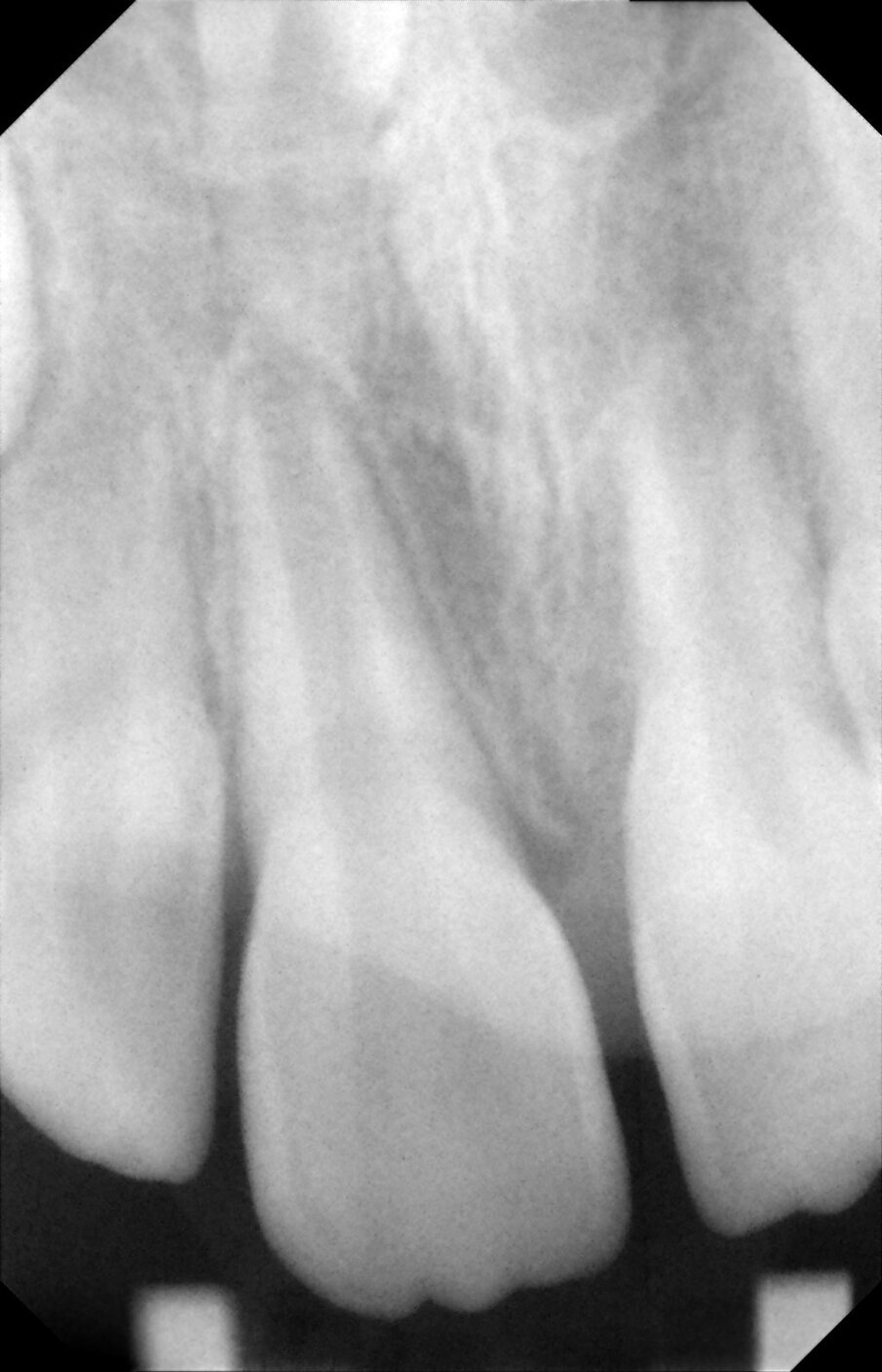 Figure 17b: Post op radiographs taken at 3, 6 and 12 months. They show lack of PDL some pulpal obliteration and replacement resorption. 