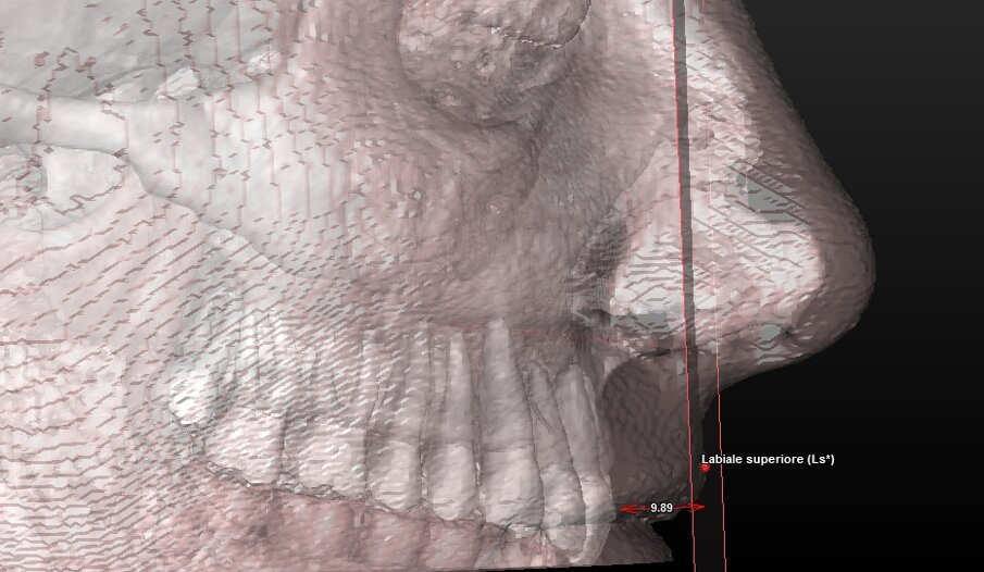 Fig. 10b_Valutazione dei tessuti molli: altezza del labbro superiore.