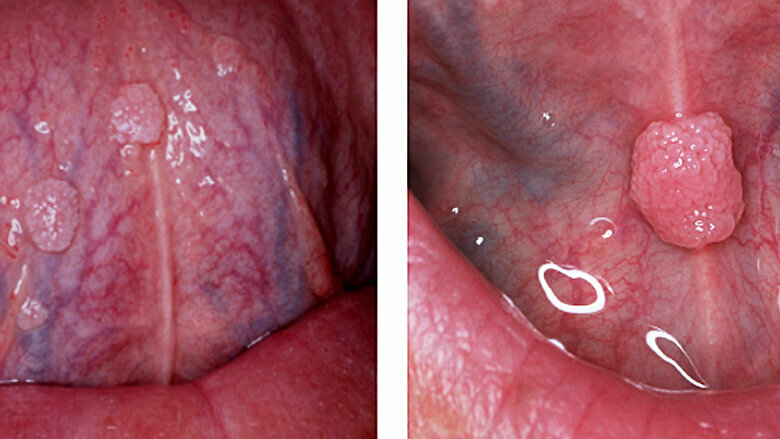 Fig. 3. Condilomas. Son lesiones que se pueden presentar en la mucosa oral, su apariencia es blanda con una superficie parecida a la coliflor.