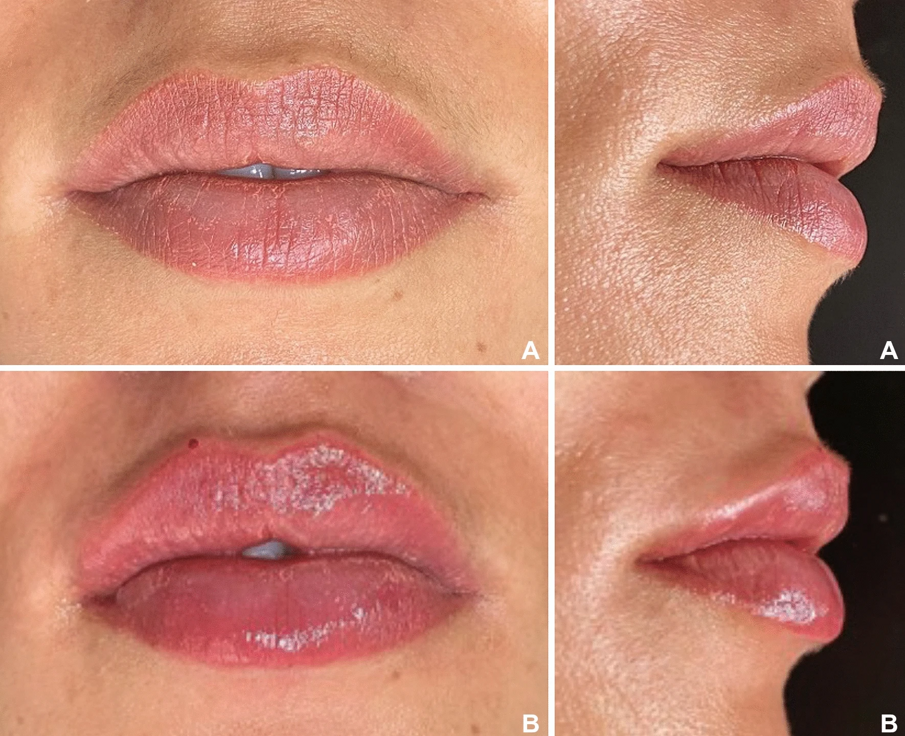 Fig. 2 - Paziente del gruppo con labbra più spesse prima del riempimento delle labbra (a) e 10 giorni dopo il riempimento (b) (Images: © De Queiroz Hernandez et al., licensed under CC BY 4.0).