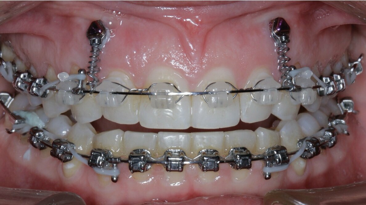 Dental News New Age orthodontics and orthopaedics with temporary