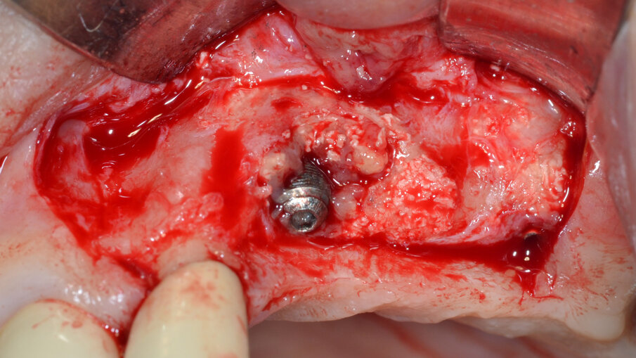 Fig. 4 - Presenza di un vasto difetto intraosseo peri-implantare con residui di biomateriale non integrato.