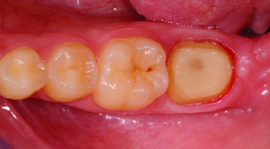 Fig. 5: Tooth preparation after removal of the temporary restoration and mechanical cleaning of the tooth (e.g. pumice paste). Note the healthy gingiva.