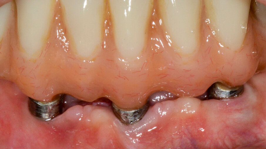 Figure 4. Post-op intra-oral photo at 6 months after therapy