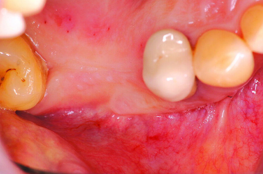 Fig. 2_Visione occlusale della lacuna dentale.