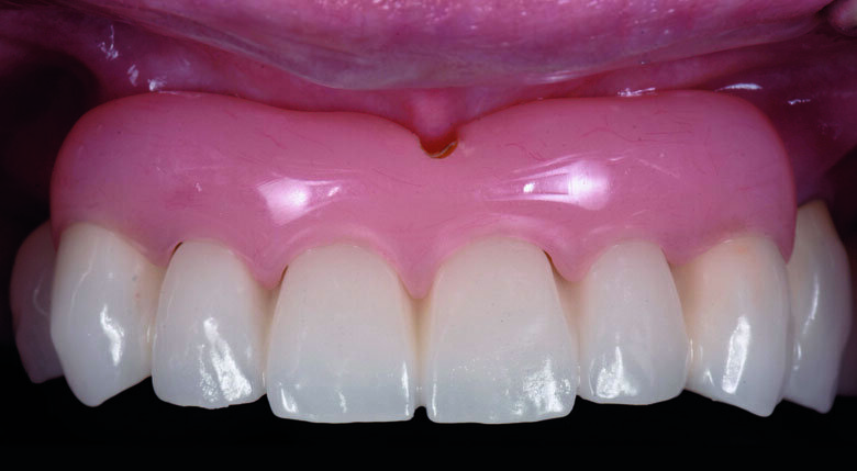 Fig 1. Pre-operative Fixed Dental Prosthesis with Acrylic Gingival Veneer