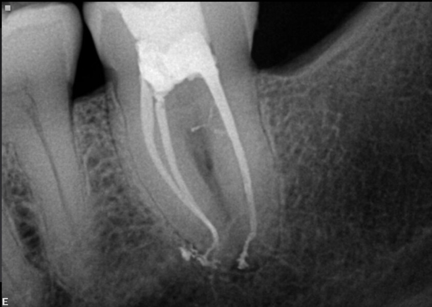 Fig. 11b: Immediate post-op radiograph showing the lateral canals filled in the coronal part of the distal canal (b).