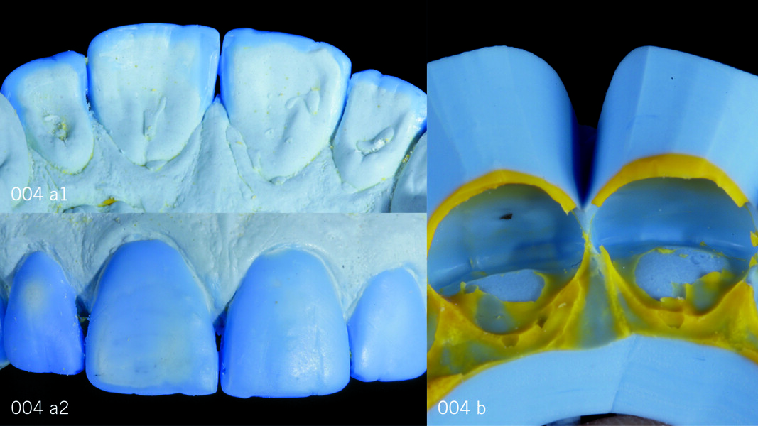 Fig. 4a1: Analogue wax-up on the gypsum model, palatal view. Fig. 4a2: Analogue wax-up on the gypsum model, vestibular view. Fig. 4b: Silicone index for moulding the mock-up in composite for the provisional restoration.
