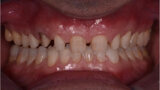 Fig. 9. Dientes posteriores sin preparación y mínima preparación de los dientes anteriores mandibulares, excepto los dientes 11-13 y 21-23 que ya estaban preparados.