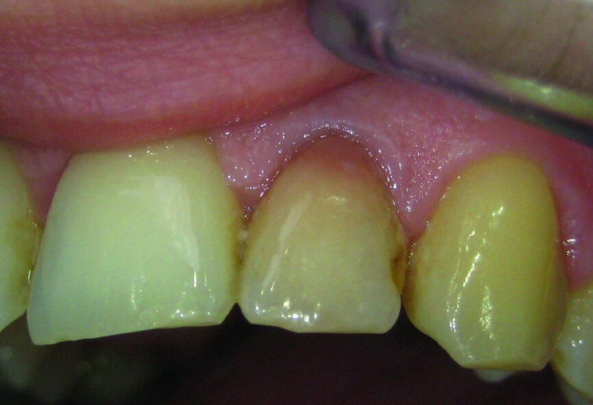 Fig. 14: Initial view: coloured, devitalised tooth #22.