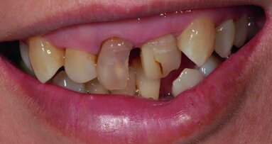 Between BOPT and BTA: A case report on shaping the gingival contour around tooth-supported restorations by means of provisional resin crowns